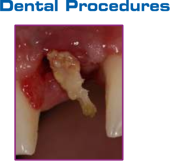 PRP-Ultra-dental